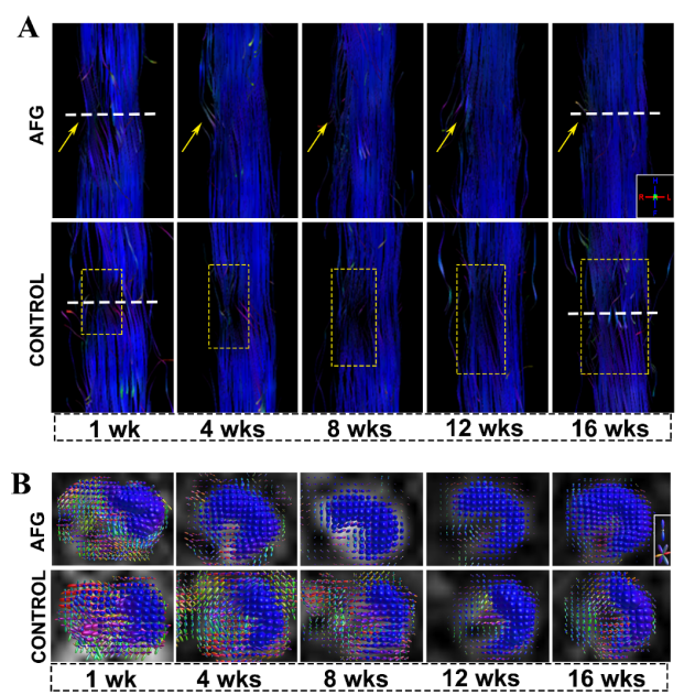 20220531-医院供图-医院供图-图2 高分辨率DTI提示AFG促进神经纤维定向再生.png